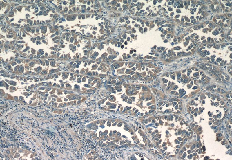 Immunohistochemistry of paraffin-embedded human lung cancer tissue slide using Catalog No:107511(RRM1 Antibody) at dilution of 1:50