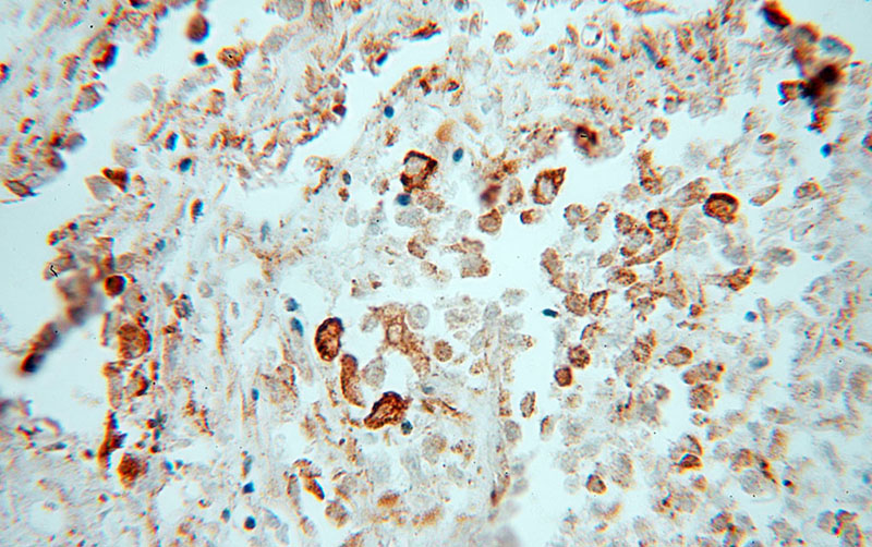 Immunohistochemical of paraffin-embedded human lung cancer using Catalog No:110374(PDIA3 antibody) at dilution of 1:100 (under 40x lens)