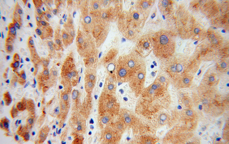 Immunohistochemical of paraffin-embedded human liver cancer using Catalog No:114179(TTR antibody) at dilution of 1:100 (under 40x lens)