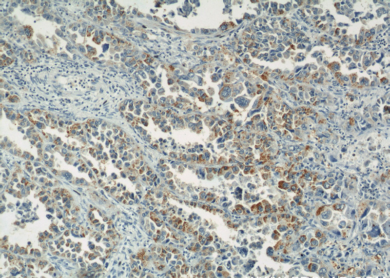 Immunohistochemical of paraffin-embedded human lung cancer using Catalog No:112277(LAMP2 antibody) at dilution of 1:50 (under 10x lens)