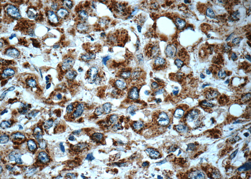 Immunohistochemistry of paraffin-embedded human stomach cancer tissue slide using Catalog No:110121(DUSP6 Antibody) at dilution of 1:100 (under 40x lens)