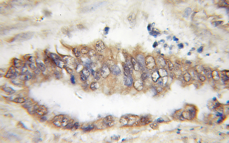 Immunohistochemical of paraffin-embedded human pancreas cancer using Catalog No:115877(TBL2 antibody) at dilution of 1:50 (under 10x lens)