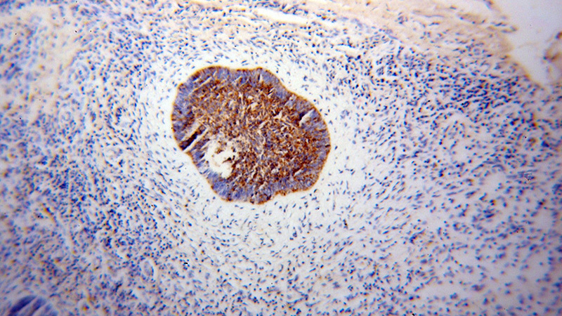 Immunohistochemical of paraffin-embedded human skin cancer using Catalog No:113286(NSDHL antibody) at dilution of 1:100 (under 10x lens)