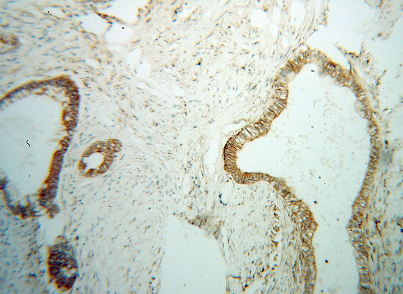 Immunohistochemical of paraffin-embedded human colon cancer using Catalog No:114681(REEP5 antibody) at dilution of 1:100 (under 10x lens)