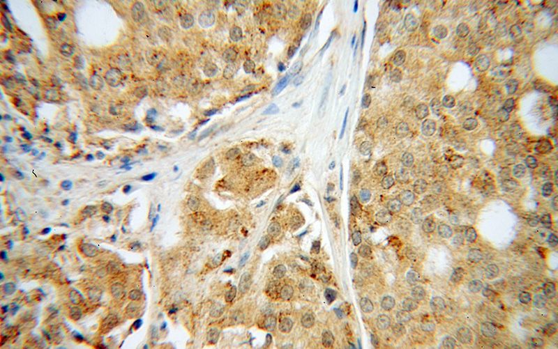 Immunohistochemical of paraffin-embedded human prostate cancer using Catalog No:111302(HEXA antibody) at dilution of 1:50 (under 40x lens)