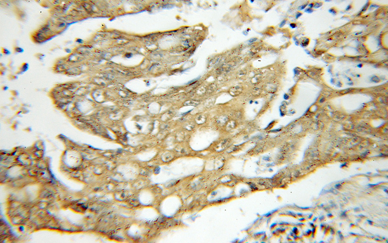Immunohistochemical of paraffin-embedded human colon cancer using Catalog No:114391(PSMC4 antibody) at dilution of 1:50 (under 10x lens)