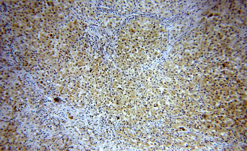 Immunohistochemical of paraffin-embedded human renal cell carcinoma using Catalog No:110739(FNIP1 antibody) at dilution of 1:50 (under 10x lens)