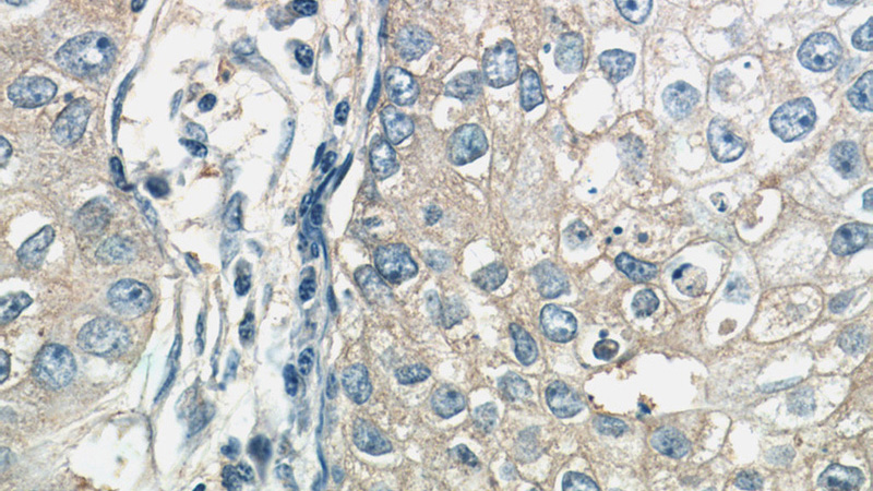 Immunohistochemistry of paraffin-embedded human breast cancer tissue slide using Catalog No:114407(RAB11FIP1 Antibody) at dilution of 1:50 (under 40x lens)