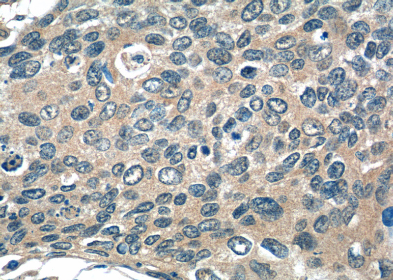 Immunohistochemistry of paraffin-embedded human cervical cancer tissue slide using Catalog No:115479(SNX27 Antibody) at dilution of 1:50 (under 40x lens)