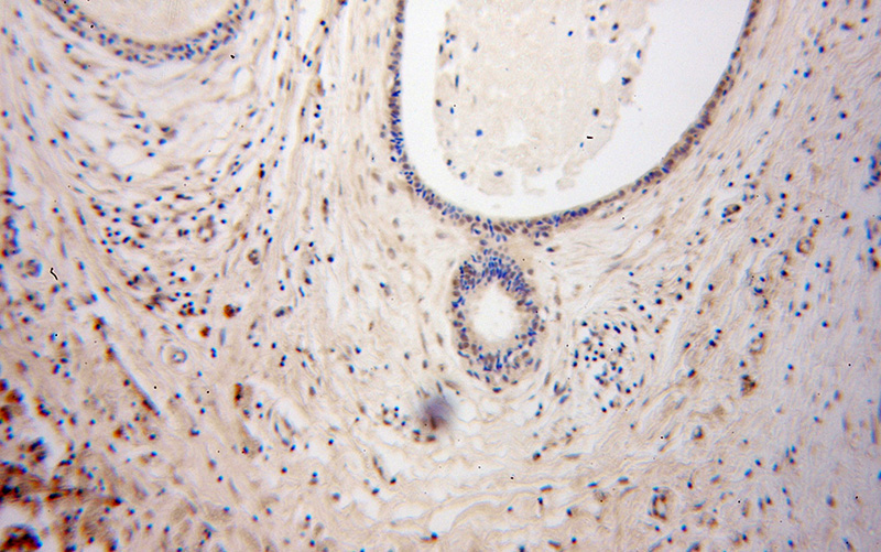 Immunohistochemical of paraffin-embedded human breast cancer using Catalog No:109905(DGCR8 antibody) at dilution of 1:100 (under 10x lens)