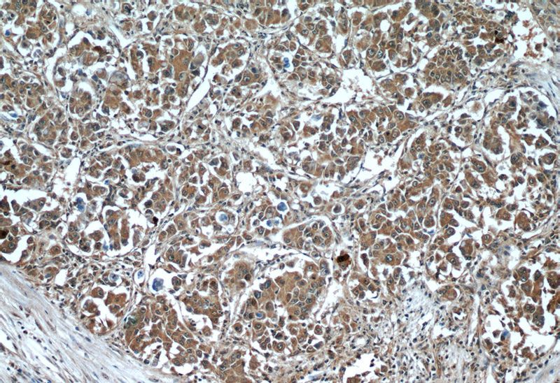 Immunohistochemistry of paraffin-embedded human liver cancer tissue slide using Catalog No:110825(GAGE2D Antibody) at dilution of 1:50 (under 10x lens)