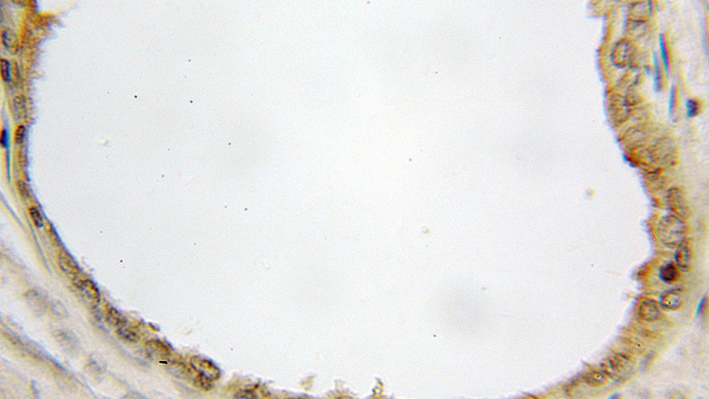 Immunohistochemical of paraffin-embedded human prostate cancer using Catalog No:110069(DPP4 antibody) at dilution of 1:100 (under 10x lens)