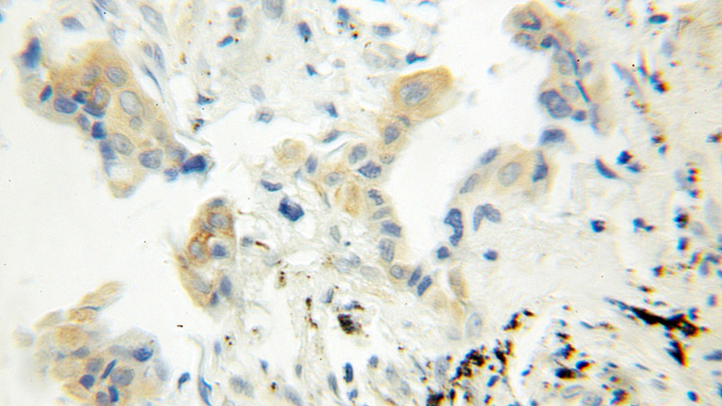 Immunohistochemical of paraffin-embedded human lung cancer using Catalog No:110607(SQS antibody) at dilution of 1:100 (under 40x lens)