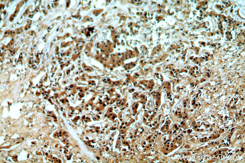 Immunohistochemical of paraffin-embedded human breast cancer using Catalog No:113460(OAS2 antibody) at dilution of 1:50 (under 10x lens)