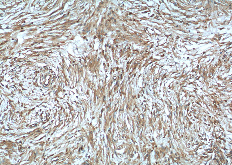 Immunohistochemistry of paraffin-embedded human meningioma tissue slide using Catalog No:113136(NF2 Antibody) at dilution of 1:50 (under 10x lens)