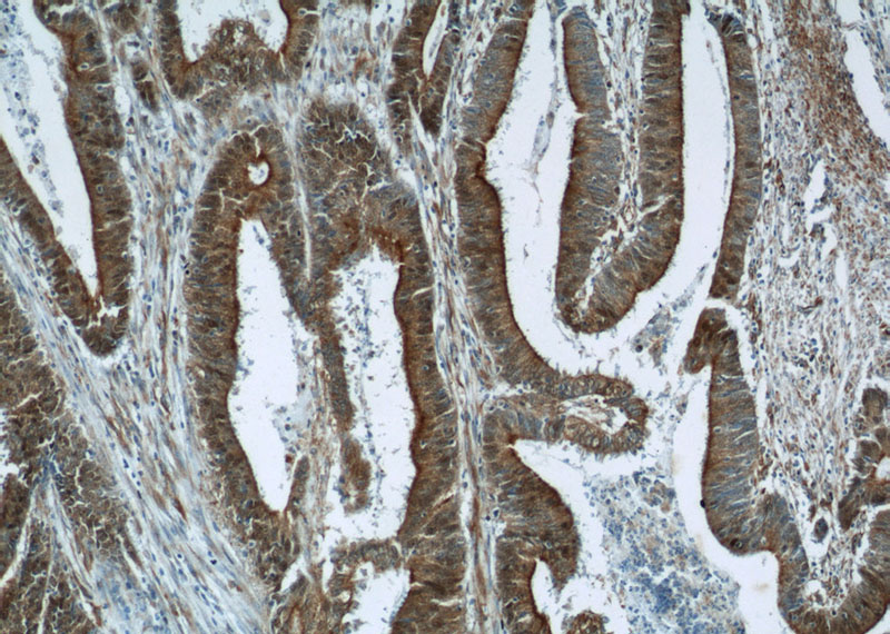 Immunohistochemistry of paraffin-embedded human colon cancer tissue slide using Catalog No:117093(B3GNT7 Antibody) at dilution of 1:50 (under 10x lens)