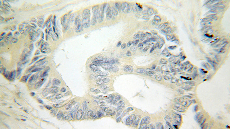 Immunohistochemical of paraffin-embedded human colon cancer using Catalog No:111521(HOOK1 antibody) at dilution of 1:100 (under 10x lens)