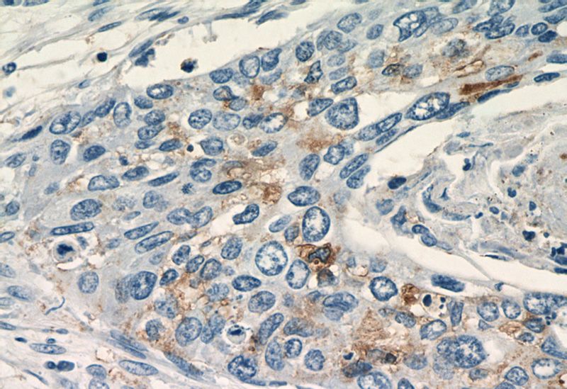 Immunohistochemistry of paraffin-embedded human cervical cancer tissue slide using Catalog No:115088(SEC61B-Specific Antibody) at dilution of 1:50 (under 40x lens)
