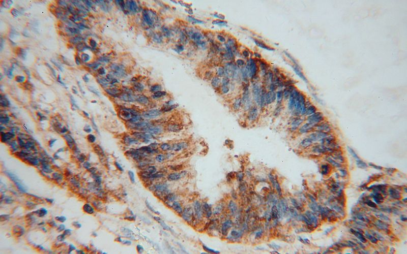Immunohistochemical of paraffin-embedded human colon cancer using Catalog No:113642(PDXK antibody) at dilution of 1:50 (under 40x lens)