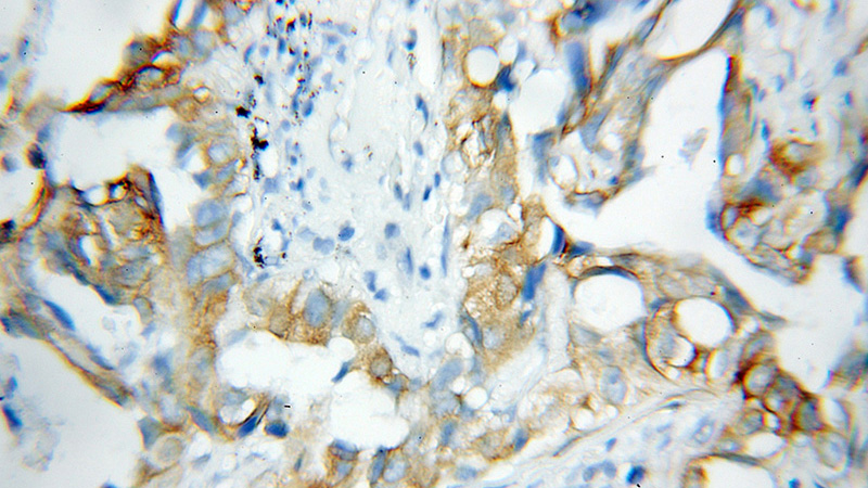 Immunohistochemical of paraffin-embedded human lung cancer using Catalog No:113617(PBXIP1 antibody) at dilution of 1:100 (under 10x lens)