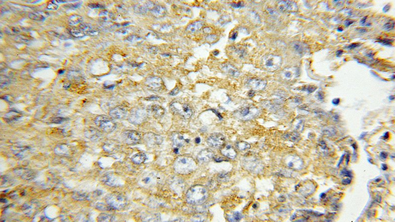 Immunohistochemical of paraffin-embedded human lung cancer using Catalog No:114744(MGRN1 antibody) at dilution of 1:100 (under 10x lens)