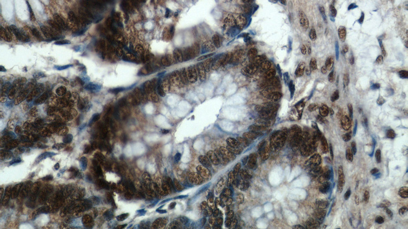 Immunohistochemical of paraffin-embedded human colon using Catalog No:115521(SP1 antibody) at dilution of 1:50 (under 40x lens)