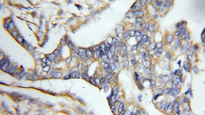 Immunohistochemical of paraffin-embedded human pancreas cancer using Catalog No:111144(GPSM2 antibody) at dilution of 1:50 (under 10x lens)