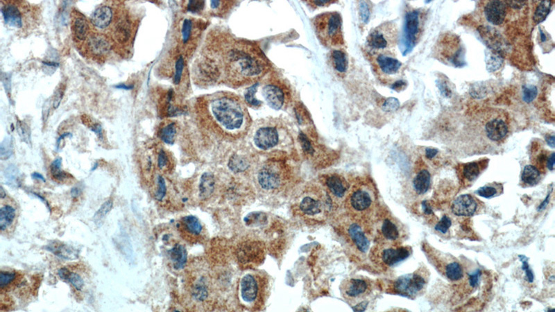 Immunohistochemical of paraffin-embedded human breast cancer using Catalog No:109994(DLK1 antibody) at dilution of 1:50 (under 40x lens)