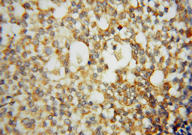 Immunohistochemical of paraffin-embedded human breast cancer using Catalog No:112833(MRPL49 antibody) at dilution of 1:50 (under 40x lens)