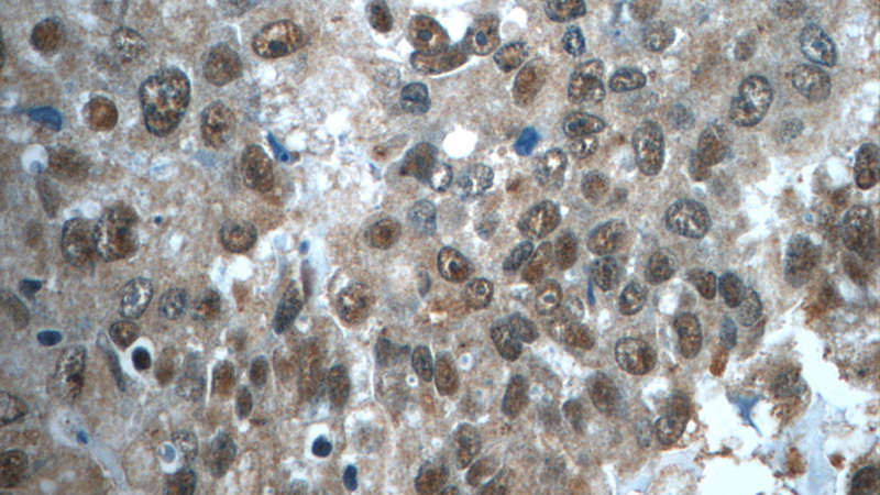 Immunohistochemistry of paraffin-embedded human breast cancer tissue slide using Catalog No:109630(CWC15 Antibody) at dilution of 1:50 (under 40x lens)