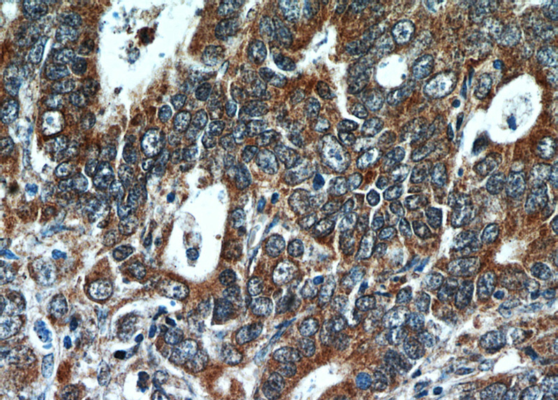 Immunohistochemical of paraffin-embedded human stomach cancer using Catalog No:111990(KIAA1199 antibody) at dilution of 1:50 (under 40x lens)