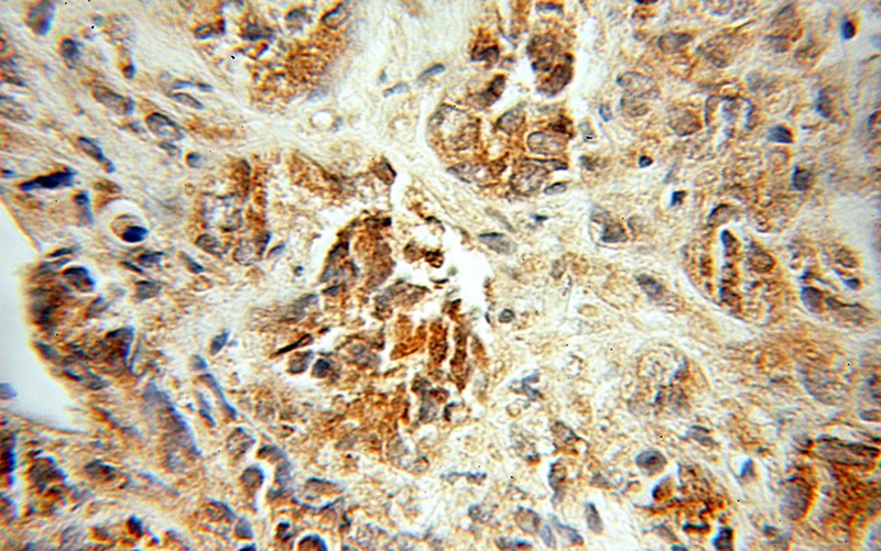 Immunohistochemical of paraffin-embedded human prostate cancer using Catalog No:113631(PDLIM5 antibody) at dilution of 1:50 (under 10x lens)