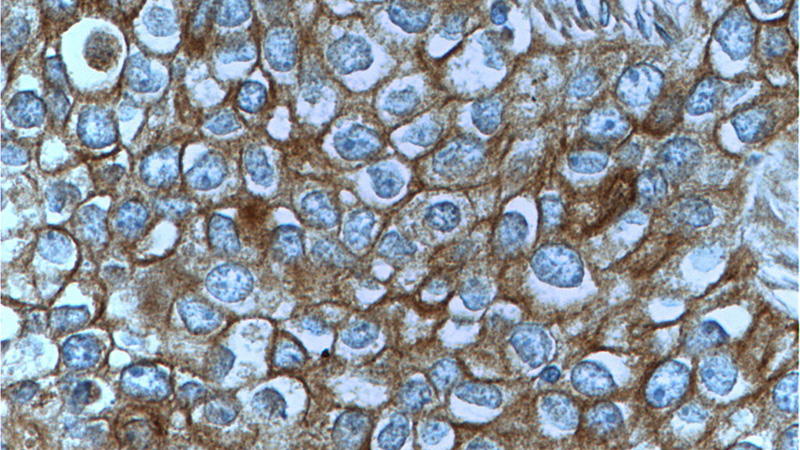 Immunohistochemistry of paraffin-embedded human breast cancer tissue slide using Catalog No:112513(MET Antibody) at dilution of 1:50 (under 40x lens)