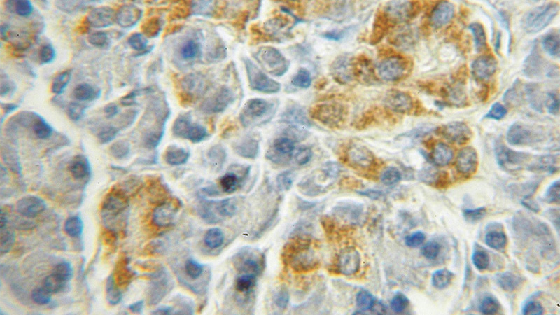 Immunohistochemical of paraffin-embedded human pancreas cancer using Catalog No:115167(SGK2 antibody) at dilution of 1:50 (under 10x lens)