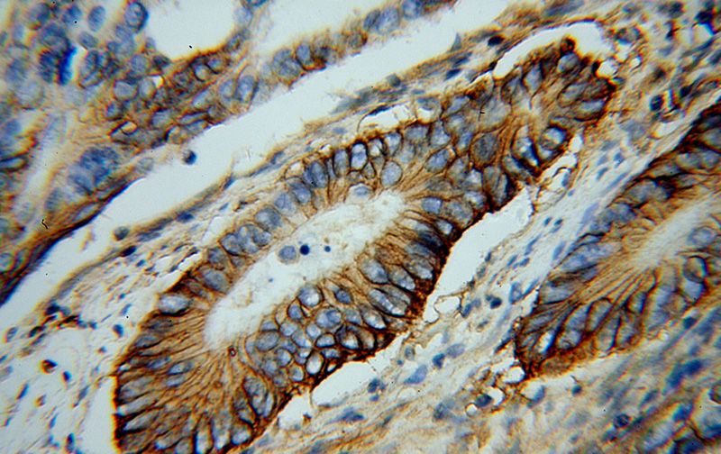 Immunohistochemical of paraffin-embedded human colon cancer using Catalog No:113194(SLC12A2 antibody) at dilution of 1:100 (under 40x lens)