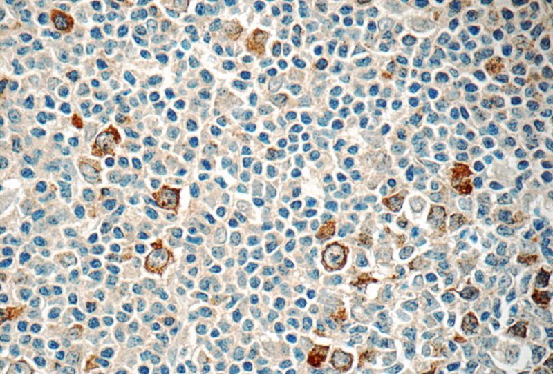 Immunohistochemistry of paraffin-embedded human tonsillitis tissue slide using Catalog No:114925(RRM2 Antibody) at dilution of 1:50 (under 40x lens)