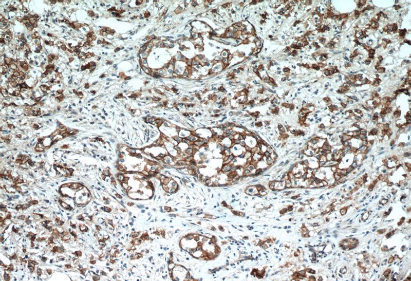 Immunohistochemistry of paraffin-embedded human breast cancer tissue slide using Catalog No:117132(B-catenin Antibody) at dilution of 1:200 (under 10x lens)