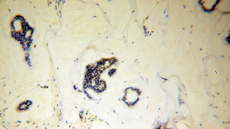 Immunohistochemical of paraffin-embedded human breast cancer using Catalog No:114510(RAD17 antibody) at dilution of 1:100 (under 10x lens)