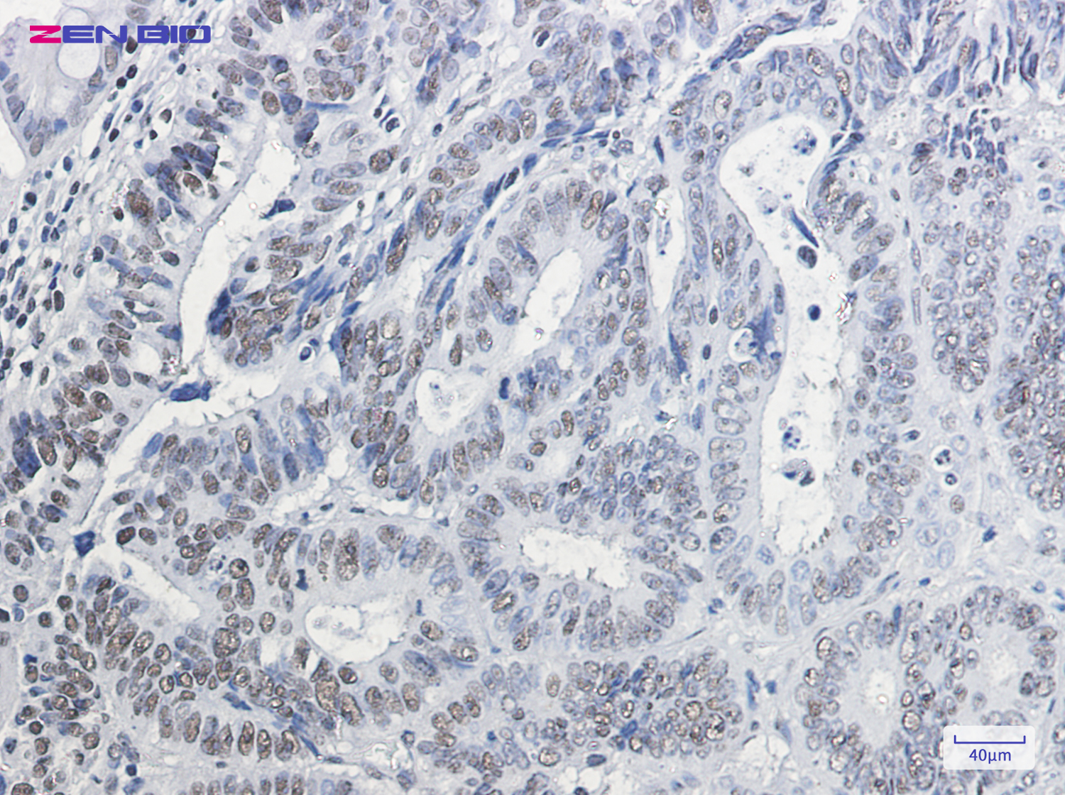Immunohistochemistry of HP1 gamma in paraffin-embedded Human colon cancer tissue using HP1 gamma Rabbit pAb at dilution 1/20