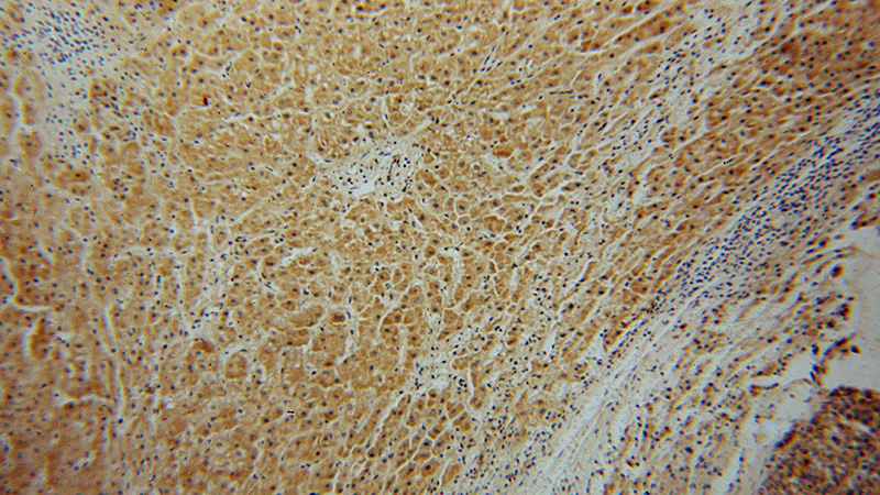 Immunohistochemical of paraffin-embedded human liver cancer using Catalog No:113771(PFKL antibody) at dilution of 1:50 (under 10x lens)