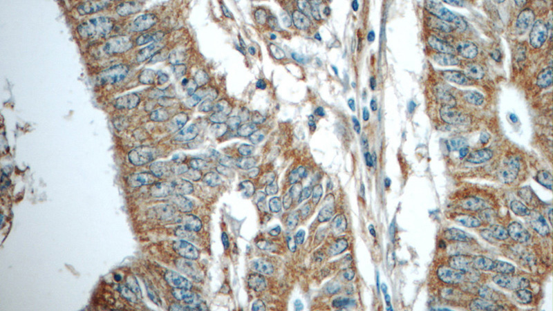 Immunohistochemistry of paraffin-embedded human colon cancer tissue slide using Catalog No:108704(C20orf46 Antibody) at dilution of 1:50 (under 40x lens)