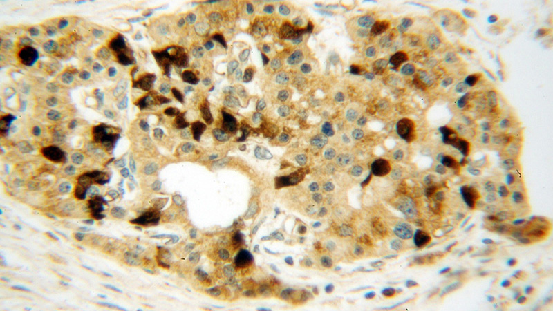Immunohistochemical of paraffin-embedded human pancreas cancer using Catalog No:108942(CBS antibody) at dilution of 1:100 (under 40x lens)