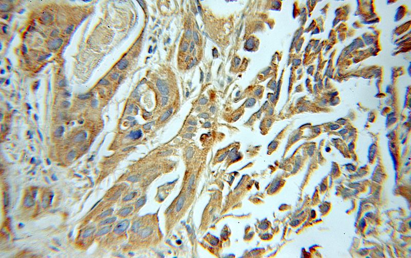 Immunohistochemical of paraffin-embedded human prostate cancer using Catalog No:113886(PICK1 antibody) at dilution of 1:50 (under 25x lens)