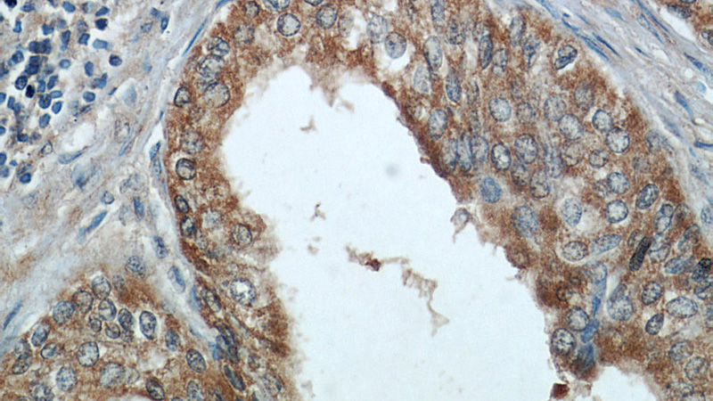 Immunohistochemical of paraffin-embedded human prostate hyperplasia using Catalog No:113322(ODC1 antibody) at dilution of 1:50 (under 40x lens)