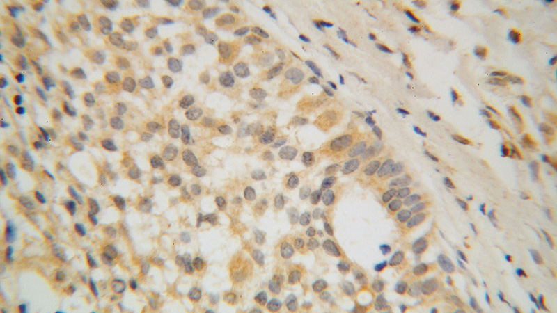 Immunohistochemical of paraffin-embedded human breast cancer using Catalog No:110112(DUS3L antibody) at dilution of 1:100 (under 40x lens)