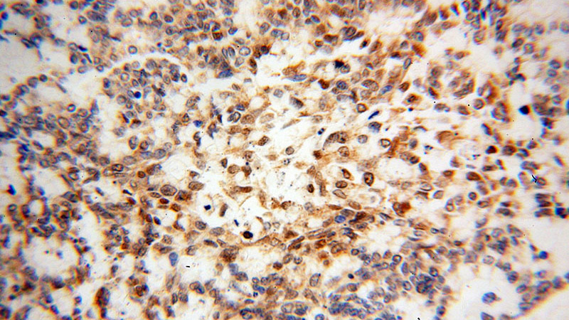 Immunohistochemical of paraffin-embedded human colon cancer using Catalog No:115218(Sestrin2 antibody) at dilution of 1:100 (under 25x lens)