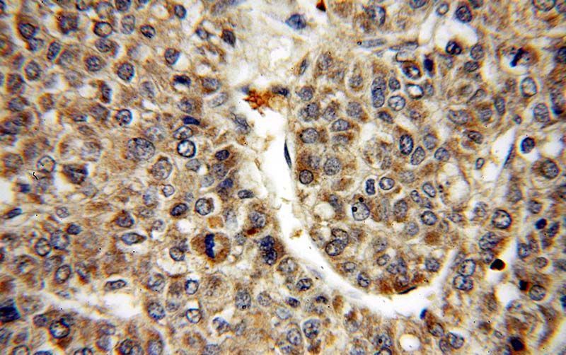 Immunohistochemical of paraffin-embedded human liver cancer using Catalog No:111677(IGF1B-Specific antibody) at dilution of 1:50 (under 40x lens)