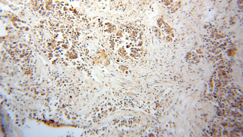 Immunohistochemical of paraffin-embedded human breast cancer using Catalog No:112837(MRPL9 antibody) at dilution of 1:100 (under 10x lens)