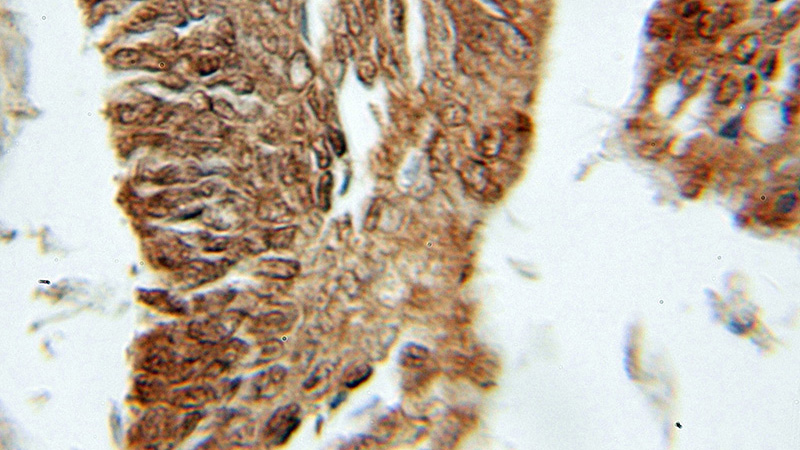 Immunohistochemical of paraffin-embedded human colon cancer using Catalog No:113733(PFDN1 antibody) at dilution of 1:50 (under 10x lens)