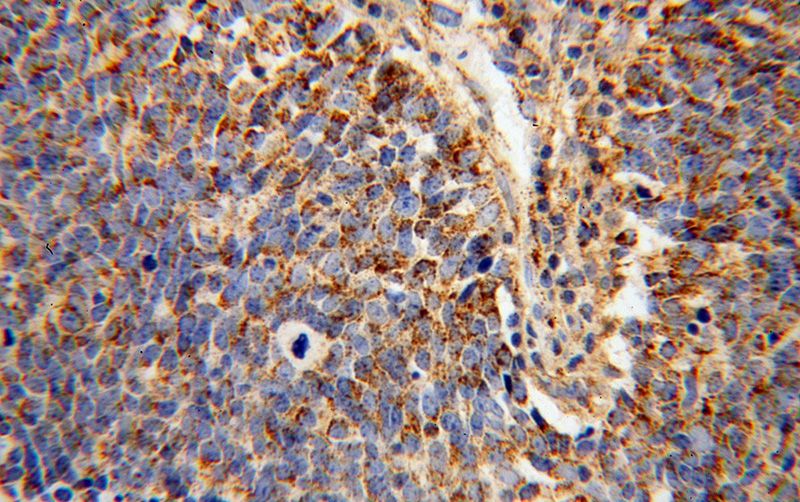 Immunohistochemical of paraffin-embedded human lung cancer using Catalog No:113331(OGDH antibody) at dilution of 1:100 (under 40x lens)